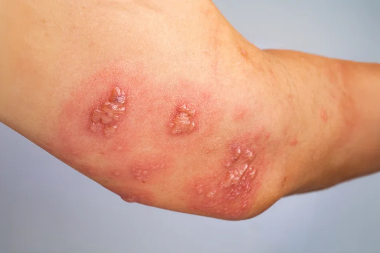 Shingles Treatment Singapore Same Day Appointment