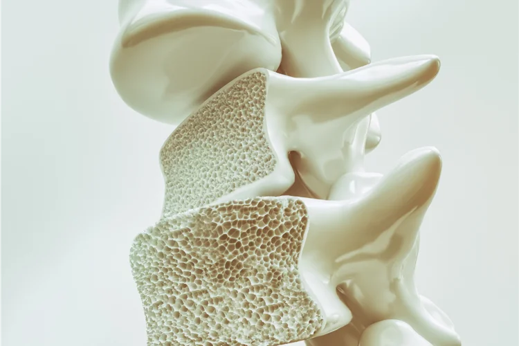 3D illustration of osteoporotic bone structure showing weakened, porous vertebrae, highlighting the impact of osteoporosis on spinal health.