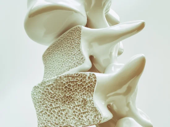 3D illustration of osteoporotic bone structure showing weakened, porous vertebrae, highlighting the impact of osteoporosis on spinal health.