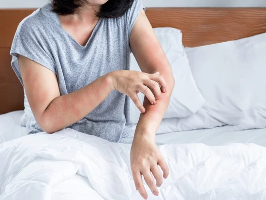 Woman sitting on bed scratching eczema flare-up caused by dust mite allergy, with white bedding and wooden headboard in the background.