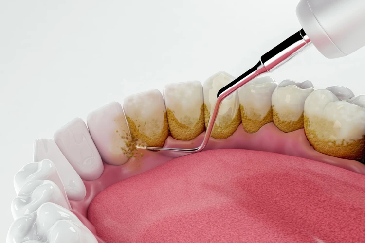 3D-rendered image of dental treatment to remove plague and dirt on teeth.