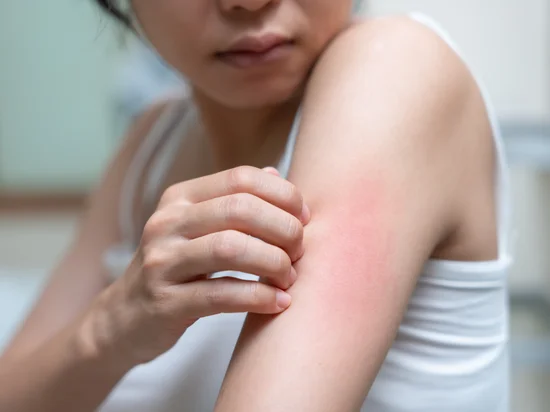 Red itchy rash with inflammation on arm, possibly from irritation or an allergic skin reaction.