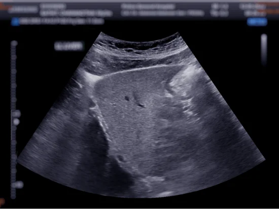 Ultrasound image of a patient’s liver as part of a liver elastography procedure to assess liver stiffness.