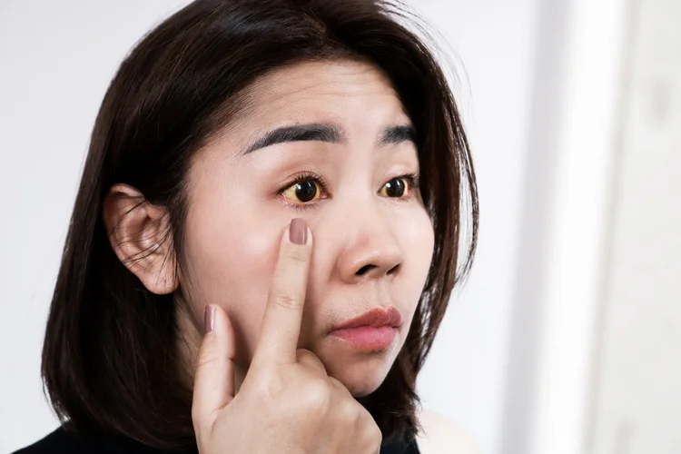Asian woman checking for eye yellowing, a possible sign of jaundice from chronic Hepatitis B.