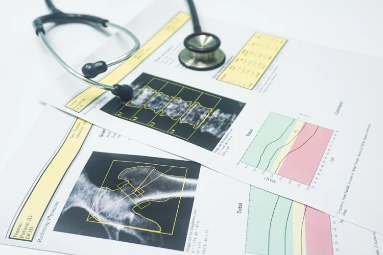 Bone mineral density test results showing the spine and hip area with T-scores and Z-scores to indicate osteoporosis risk.