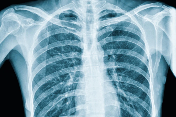 Chest X-Ray imaging of patient for medical diagnosis.