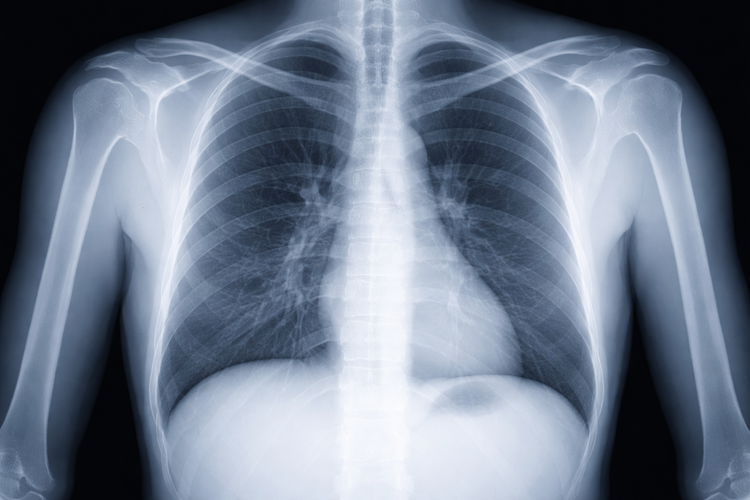 Chest X-ray used to screen for tuberculosis during ECDA medical check-up.