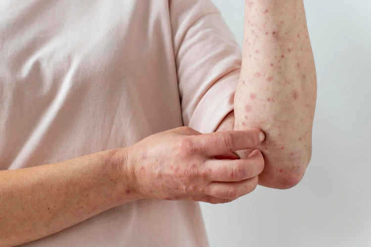 Lady suffering from Varicella / Chickenpox with distinctive red, itchy rashes all over her arms.