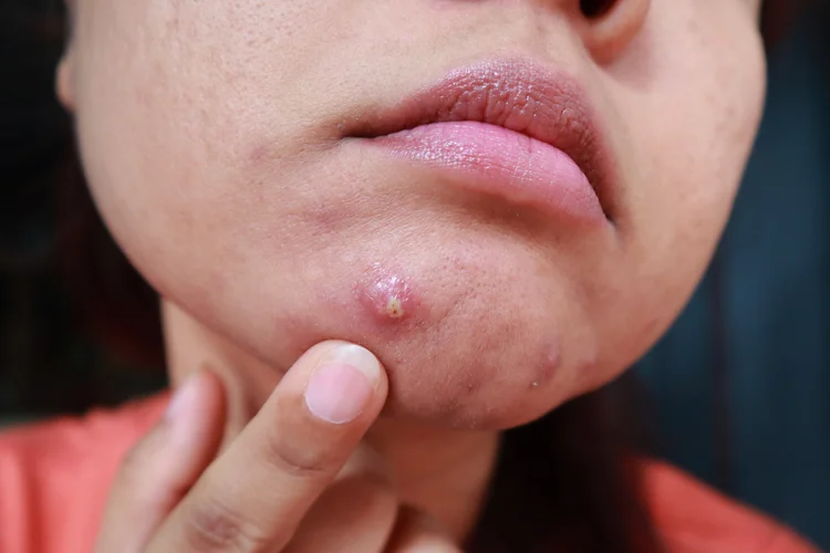 Pustule on chin showing inflammatory acne symptoms common in hormonal and cystic breakouts.