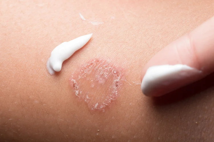 Circular rash on a person's skin with defined scaly border and central clearing, possibly ringworm or a fungal infection.