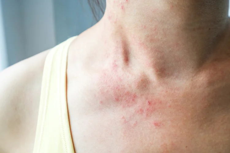 Close-up of mild eczema on woman’s neck showing redness and irritation in sensitive skin areas.