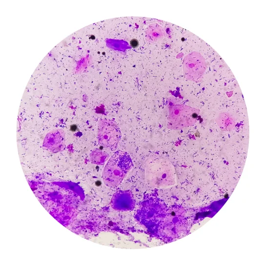 Clue cells and bacterial overgrowth under microscope indicating Gardnerella vaginalis infection.