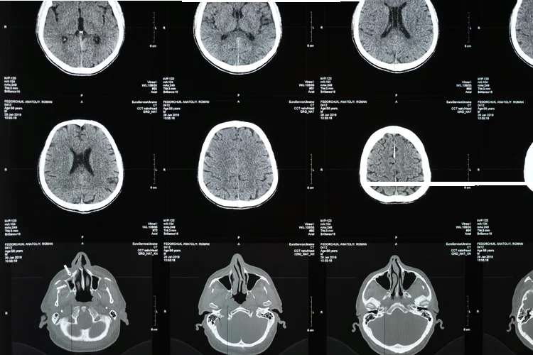 CT brain scan images highlighting skull and brain structures for trauma assessment.