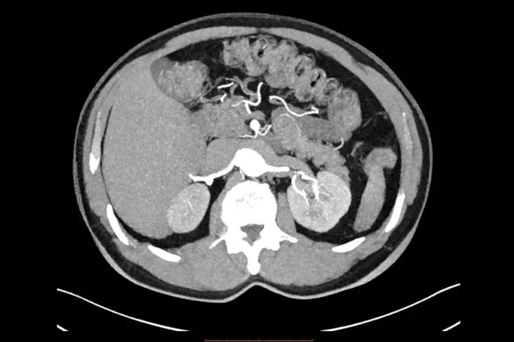 CT Calcium Score chart.