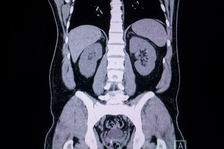 CT scan image showing abdominal and kidney structures during routine screening.
