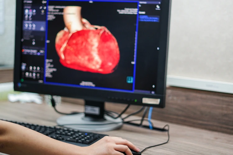Monitor screen with Computed Tomography Angiography Coronay (CTA coronary) background.