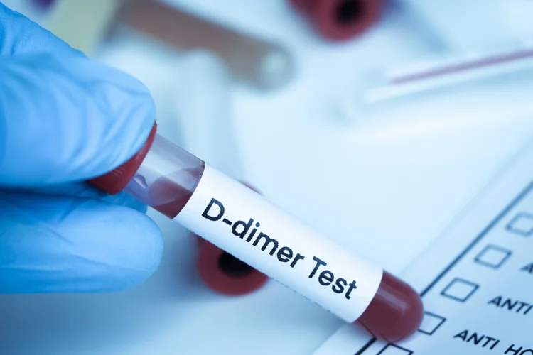 D-dimer test blood sample in a gloved hand for laboratory testing to detect clots.