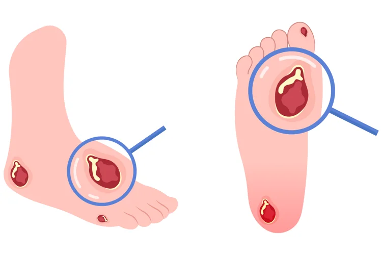 Diabetic foot ulcers are open sores or wounds that usually form on the legs or feet.