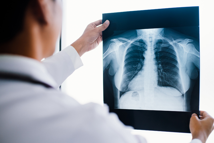 Doctor holding chest X-ray as part of tuberculosis screening for pre-employment medical check-up.