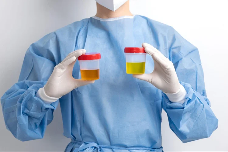 Doctor holding up samples for urine analysis as part of basic health screening in singapore.