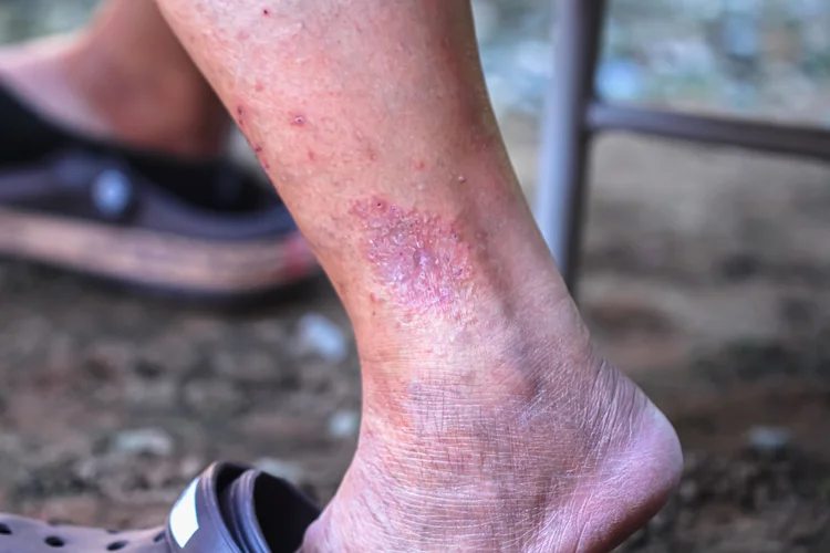 Dry scaly patches on a person's leg with flaking and rough texture, possibly indicating eczema or a fungal infection.