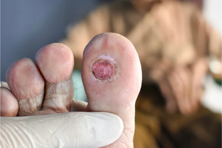 Early-stage diabetic foot ulcers can present with open sores that take a long time to heal, along with redness and swelling in the affected area.