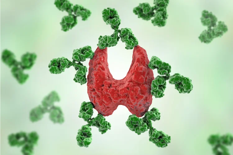 Hashimoto's disease causing hypothyroidism.