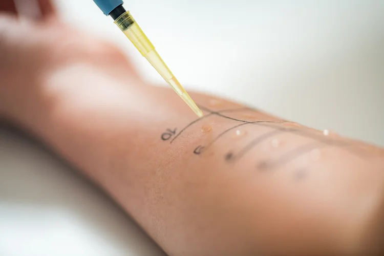 Healthcare provider performing skin prick test on patient to identify possible eczema allergens.
