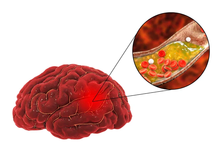 Hemorrhagic stroke as a type of stroke.