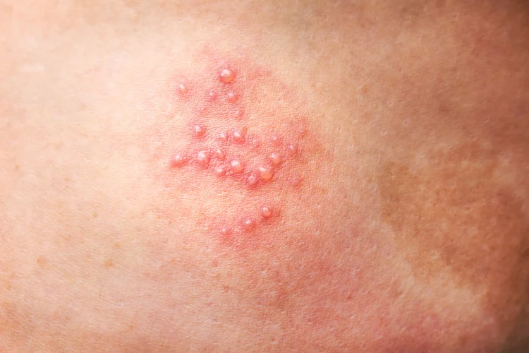 Herpes rashes near a person’s genital area appearing as painful, pus-filled blisters that cluster together and crust over.