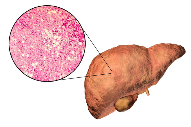 Fatty liver illustration showing fat buildup and liver cell damage from steatohepatitis.
