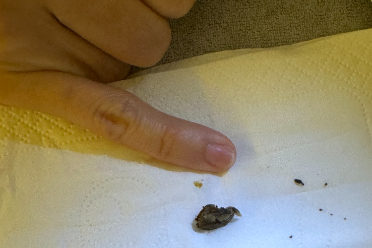 Impacted ear wax removed during a professional ear wax removal procedure displayed on a tissue.