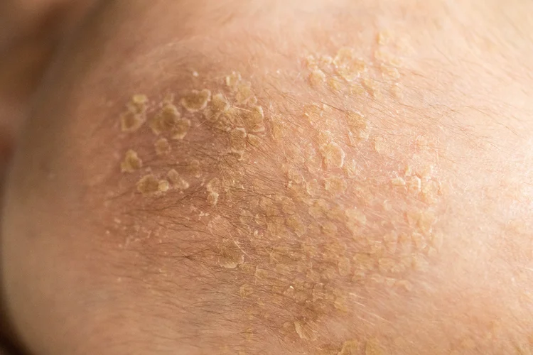 Infected rash with yellowish crusting and scaling on a person's skin, suggesting weeping eczema or a bacterial infection.