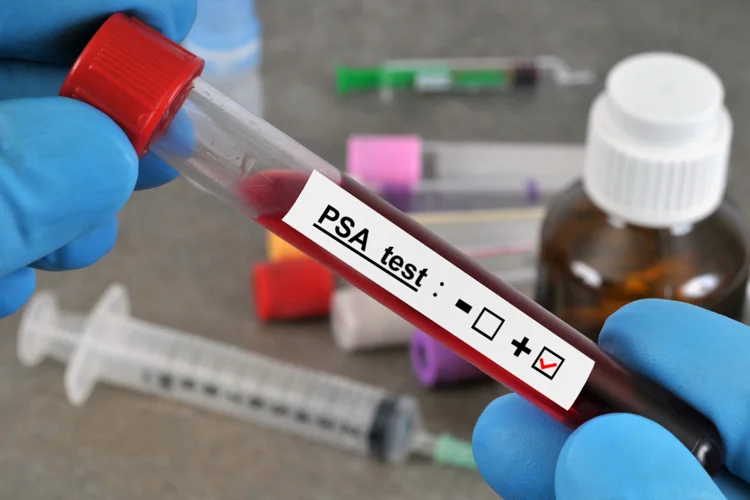 Male patient’s blood sample sent to a laboratory for analysis of prostate-specific antigen (PSA) levels to detect prostate cancer.