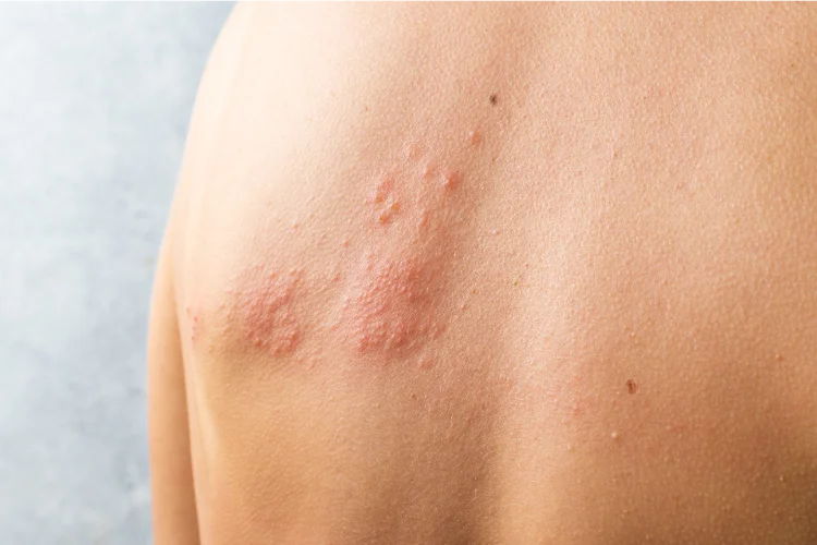 Man experiencing shingles with a red rash and blisters on one side of his back that are painful and sensitive to touch.