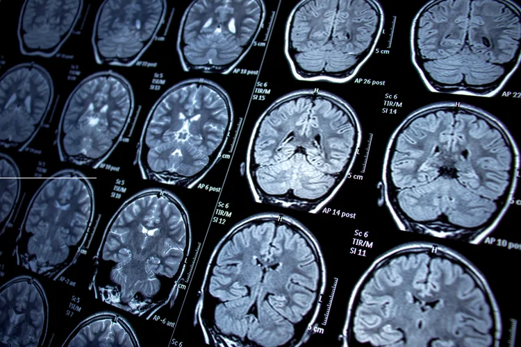 MRI brain scan images showing soft tissue contrast for diagnosing neurological conditions.