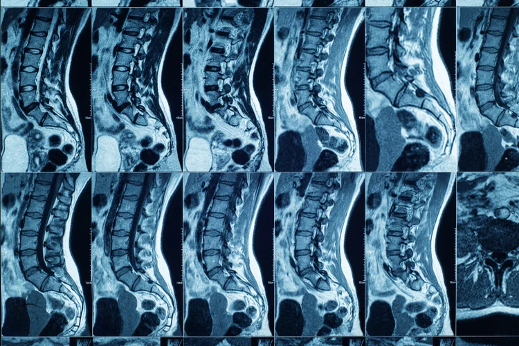 MRI spine scan showing lumbar vertebrae and soft tissue for back or nerve evaluation.