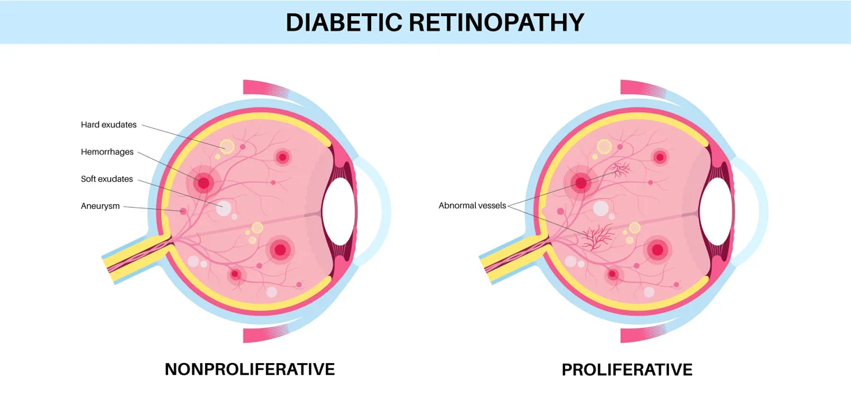 Non-proliferative and proliferative types of diabetic retinopathy.