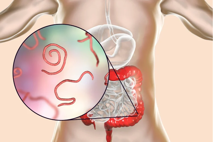 Parasitic infection in gastrointestinal tract.