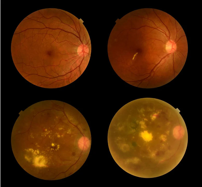 Photo images of retinas of people with diabetic retinopathy.