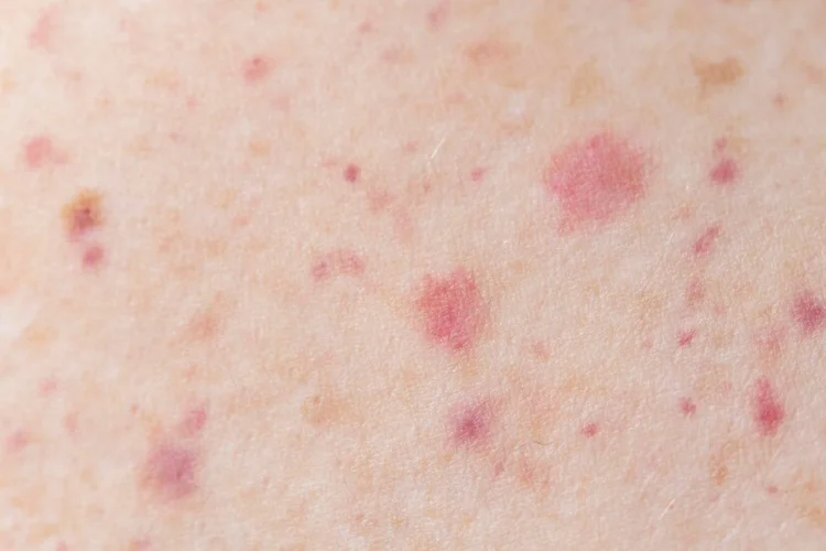 Rashes as symptom of STDs.