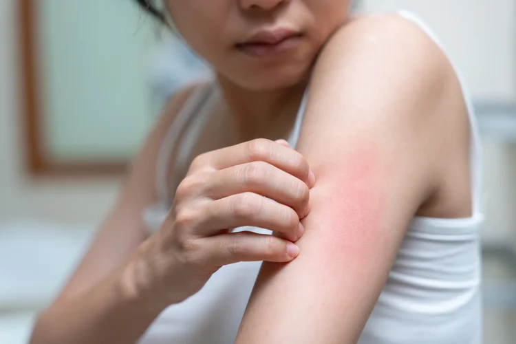 Red itchy rash on arm with inflammation and slight discolouration, possibly due to skin irritation or allergic reaction.
