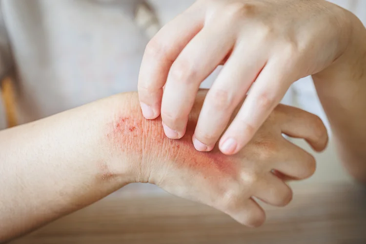 Person scratching itchy rash on hand with redness and swelling, possibly due to skin allergies or irritant contact dermatitis.