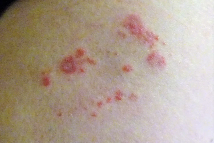 Person with Shingles condition on skin.