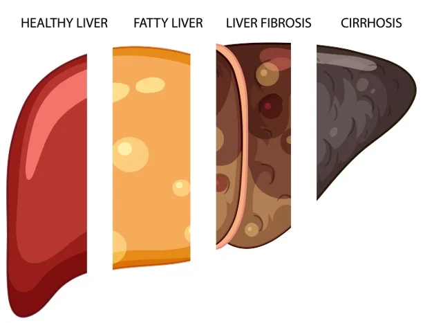 Stages of liver disease, from healthy to fibrosis and cirrhosis, can be assessed by measuring liver stiffness through elastography.