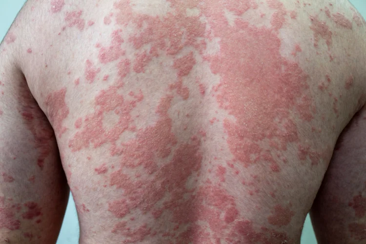 Swollen thickened skin with raised inflamed patches, possibly from chronic irritation, repeated scratching, or lichenification.