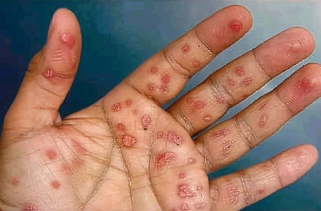 Person suffering from Syphilis-Rashes on his palm.