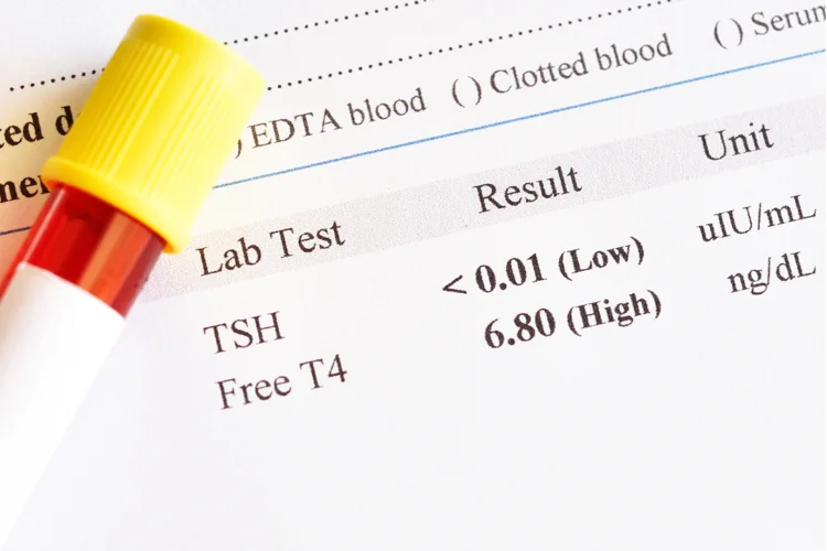 Thyroid function tests for hyperthyroidism.