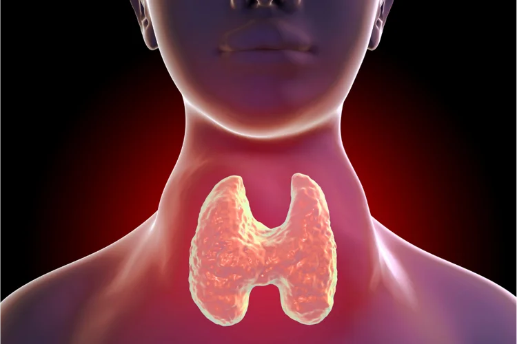 Thyroid glands producing excessive thyroid hormone leading to hyperthyroidism.