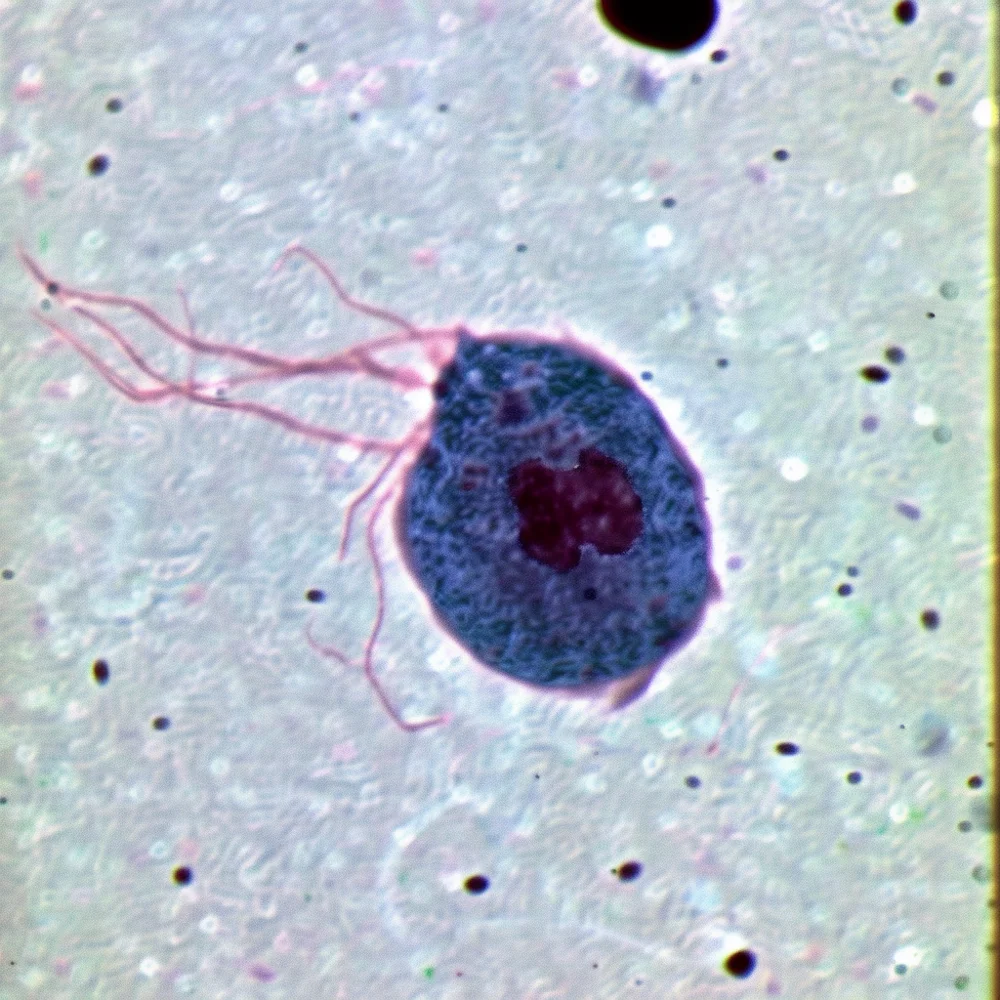 Trichomonas Vaginalis causing Trichomoniasis.